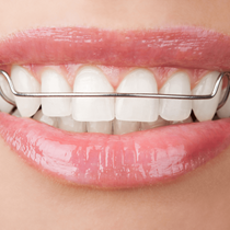 Dental Bonding and Contouring
