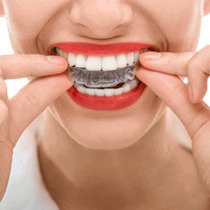 Dental Bonding and Contouring