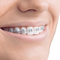 Dental Bonding and Contouring